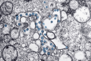 Yeni Araştırma Parkinson Hastalığında Protein Birikimini Engelliyor